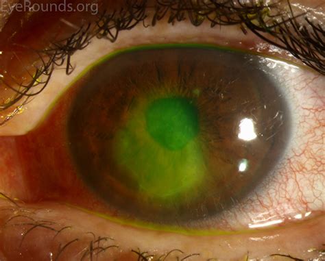 Corneal Ulcer Fluorescein