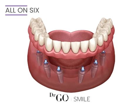 All-on-4 and All-on-6 Implant Systems: Comprehensive Oral ...
