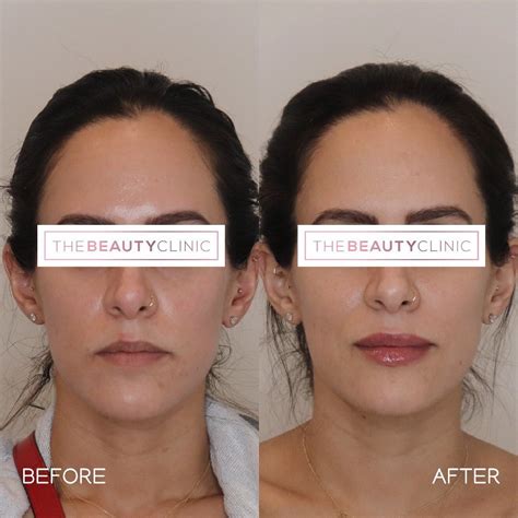 Before and After: Lip Filler - The Beauty Clinic