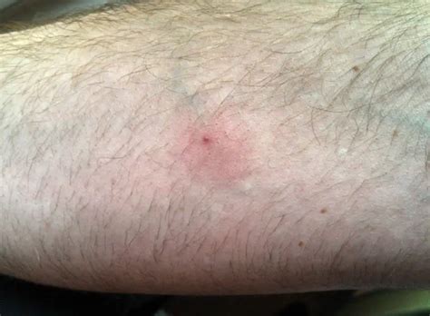 Ant bites | pictures, treatment & home remedies, symptoms