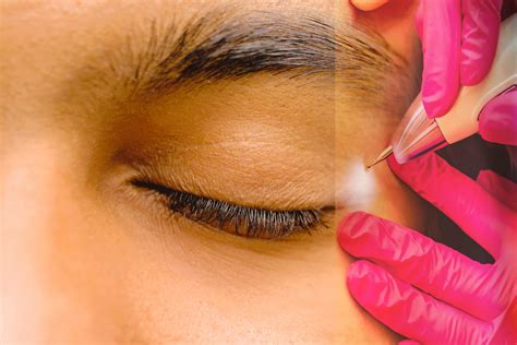 Plasma Pen Eye Damage at Timothy Mitchell blog