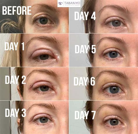 Festoons After Lower Blepharoplasty at Diane Straub blog