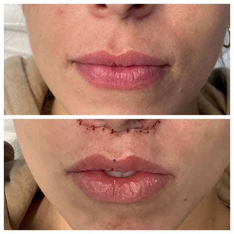 Lip Lift Before And After Surgery at Liam Threlfall blog