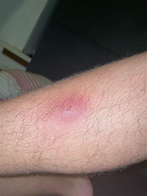 Large Lump Between Legs at Natasha Groom blog