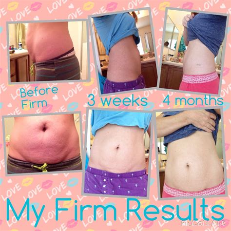 No kidding....this is my baby belly (C-section) before and after using ...