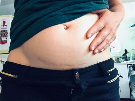 How To Hide C Section Scar at Wanda Devine blog