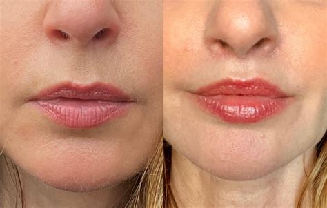 Dr. Amy Hsu, Beverly Hills: 3 months post lip lift surgery : r/plasticsurgeonreviews