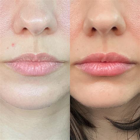 My before and after lip fillers | Scrolller
