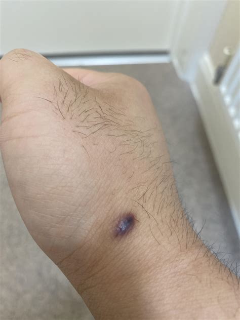 I have a patchy scab that won’t heal, at first I though it was a wart ...