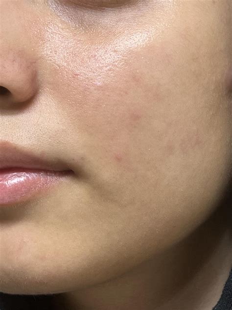 Damaged Skin Barrier?? : r/SkincareAddicts