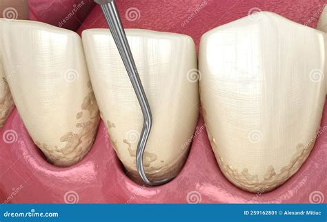 Closed Curettage: Scaling and Root Planing Conventional Periodontal Therapy. Medically Accurate ...