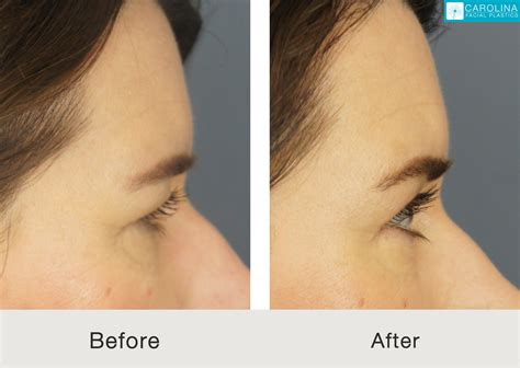 Plastic Surgery Endoscopic Brow Lift at Claire Ryder blog