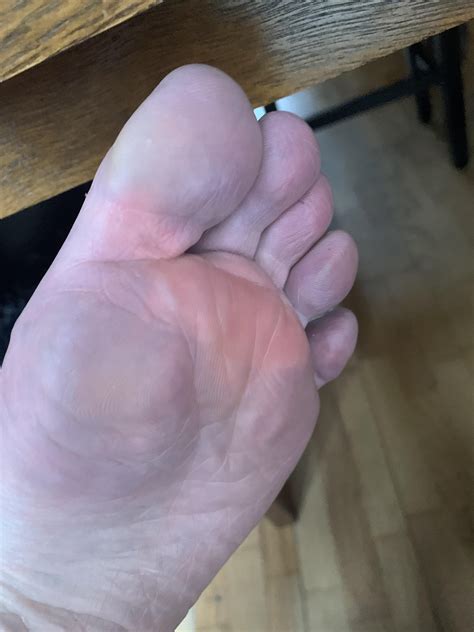 Feet Turn Purple In Bath at Jacklyn Montiel blog