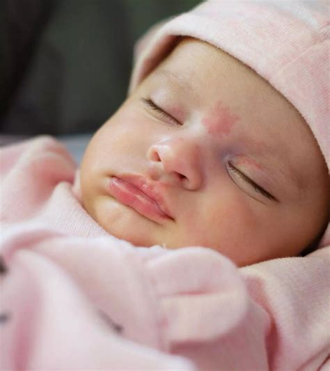 Baby Lip Blisters: Causes, Symptoms, And Treatment