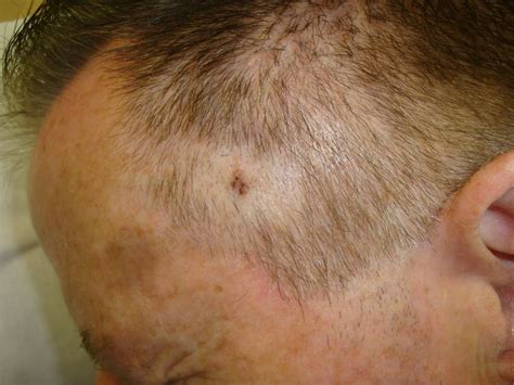 Skin Cancer On Head
