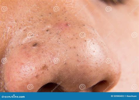 Ugly Pimples, Acne, Zit And Blackheads On The Forehead Of A Teenager Royalty-Free Stock ...