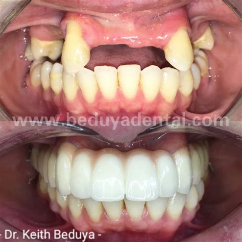 Fixed Bridge - Beduya Dental