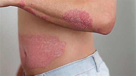 Resistant Fungal Skin Infections - Sparsh Skin Clinic