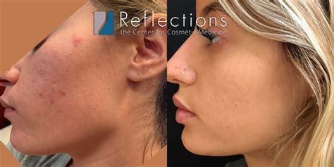 Chemical Peel For Acne Scars And Discoloration at Harriet Ridgeway blog