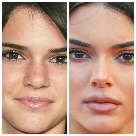 Kendall Jenner Plastic Surgery - A Complete History | WHO Magazine ...