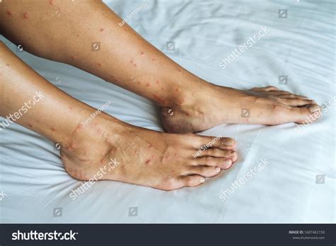 Sand Fly Bites Speed Healing