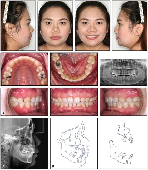 Managing Orthodontically Created Alveolar Exostosis