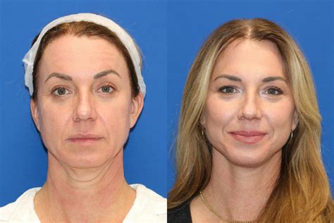 Patient 87147711 | Fat Transfer Before & After Photos | Carmel Valley Plastic Surgery