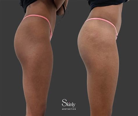 Liquid Butt Lift Before and After NYC | Non-Surgical Butt Enhancement Results