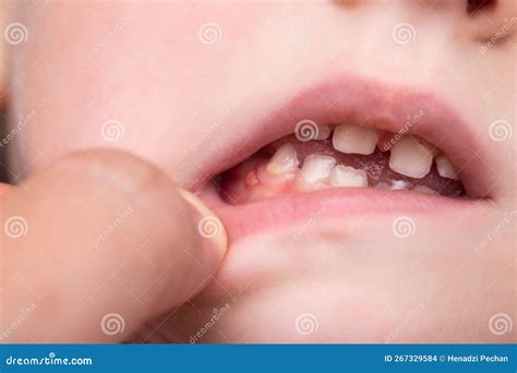 A Bump is a Tumor on the Tooth Gum in a Child. Periodontitis in Children Due To a Tooth with ...