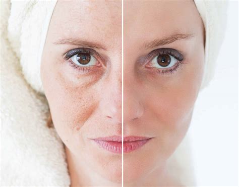 How To Prevent And Treat Hyperpigmentation | PCH MedSpa