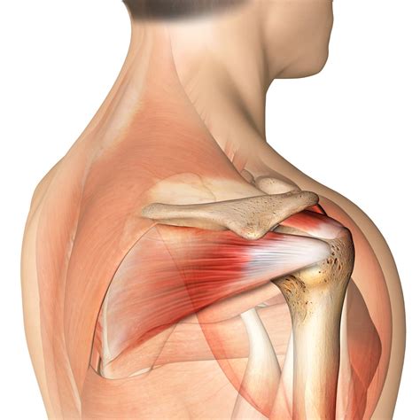 Rotator Cuff Tear Location Of Pain at Darren Henderson blog