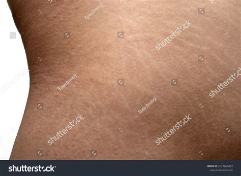 Stretch Marks On Womans Buttocks Skin ภาพสต็อก 2027866493 | Shutterstock