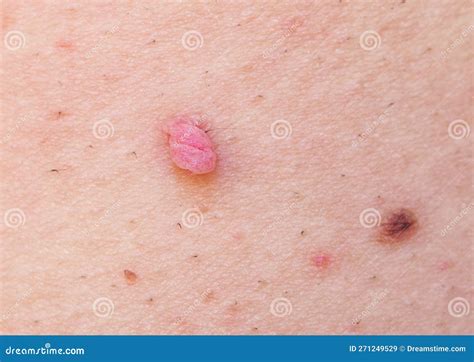 Pedunculated Skin Tag Or Acrochondon Or Soft Fibroma. Papilloma On ...