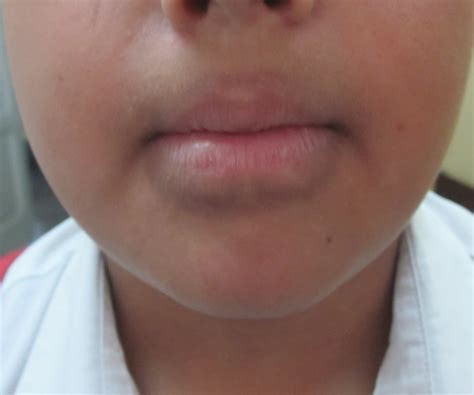 Irritant Contact Dermatitis - DermAlive