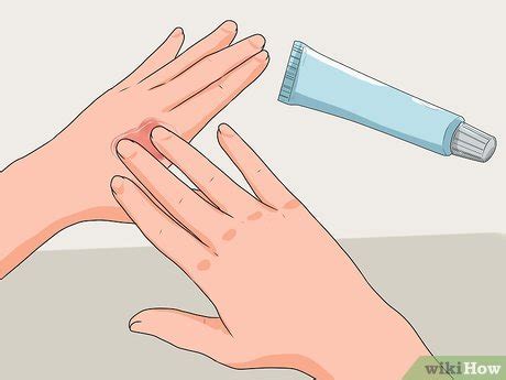 Как лечить волдыри от ожога - wikiHow