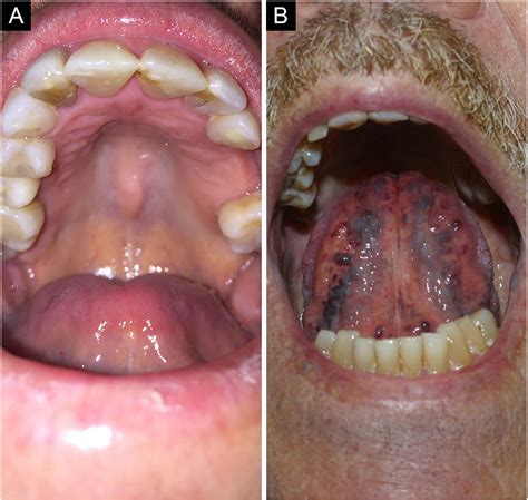 Unilateral Torus Mandibularis