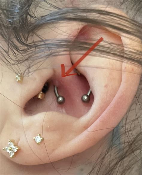 Daith Piercing Keloid at Gary Delariva blog