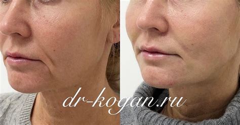 Что такое морщины-марионетки и как их убрать - Cosmetic-clinic