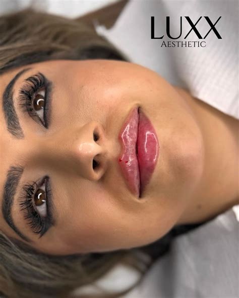 Luxx Aesthetic | Estética Avançada | Lábios volumosos e naturais com preenchimento labial! 💋 ...