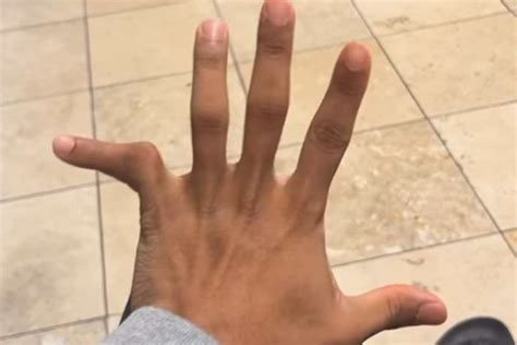 Broken Finger Vs Jam