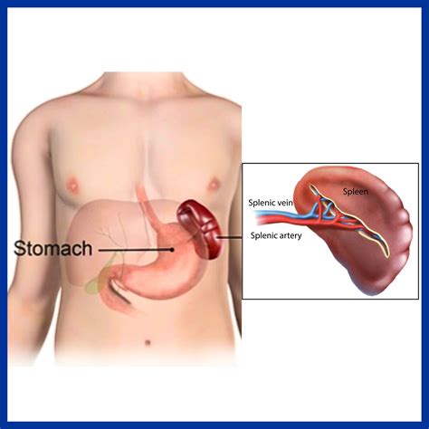 Living Without Your Spleen