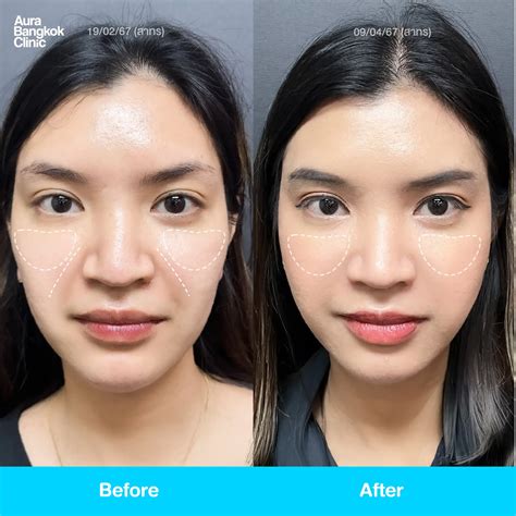 Nasolabial Fold Filler: Guide to Restore Volume and Youth