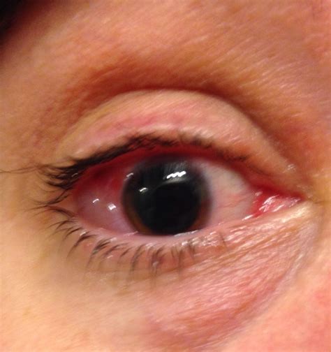 Avastin Eye Injections Side Effects at Kaitlyn Fitzhardinge blog