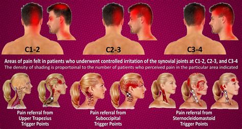Neck Pain Causing Headache