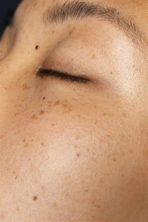 What is hyperpigmentation? – Lumina Aesthetics