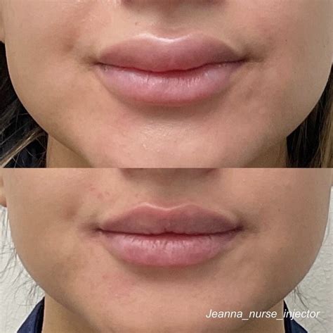 When Lip Filler Goes Bad: Can You Dissolve Lip Filler?