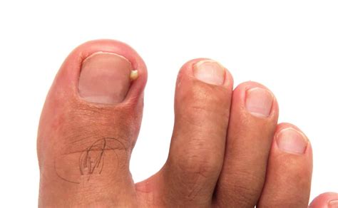 How to Prevent and Treat Ingrown Toenails - Feet First Clinic