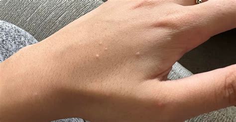 ¿Does anyone know what are these little bumps in my skin, and why do they form? I just cant get ...