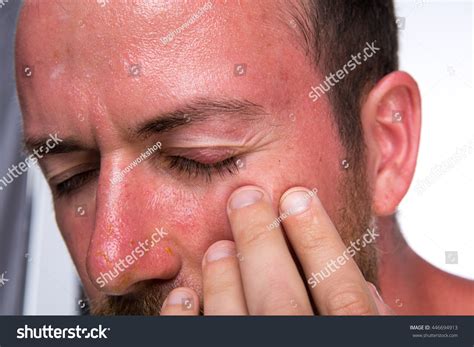 Sunburn Blisters On Face