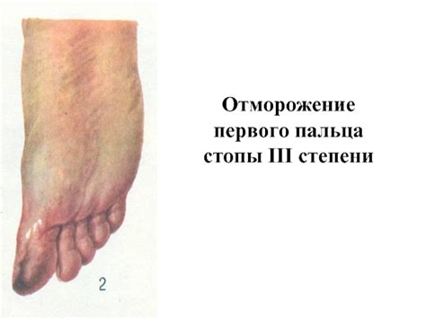 Первая помощь при обморожении и ожоге разных степеней презентация, доклад